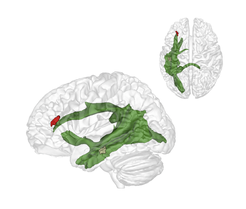 Als eine Art Datenautobahn verknüpft der Fasciculus Arcuatus (grün) ab etwa dem vierten Lebensjahr zwei wesentliche Hirnareale miteinander: Eine Region im hinteren Schläfenlappen (braun), die uns im Erwachsenenalter hilft, über andere Menschen und deren Gedanken nachzudenken, und ein Areal im Frontallappen im vorderen Großhirn (rot), das uns vermutlich dabei hilft die Gedanken anderer und die wirkliche Welt auf anderen Abstraktionsebenen zu halten.